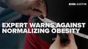 Expert warns obesity <b>normalization</b> hides growing health risks for ...の画像